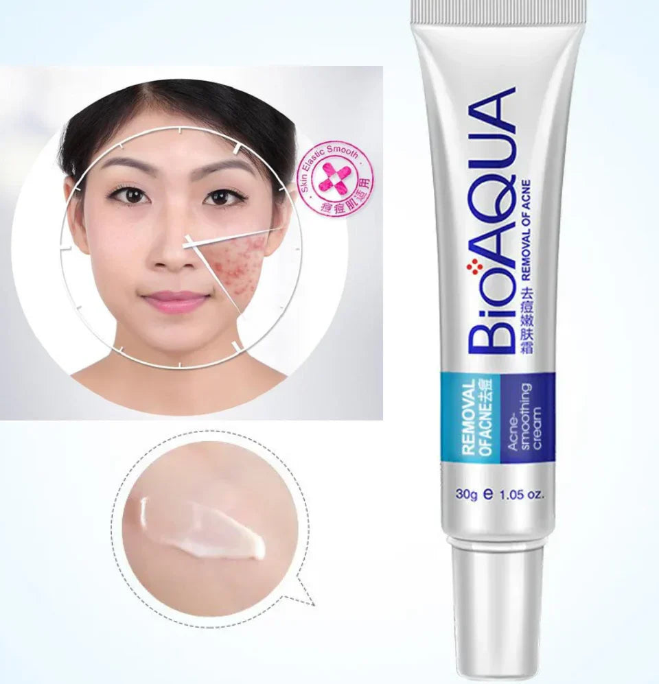 BIOAQUA Removal of Acne Complete Set | Acne Cleanser, Acne Serum & Acne Cream